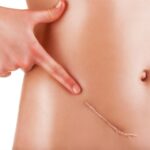 new-blood-test-offers-promising-advances-in-ovarian-cancer-treatment