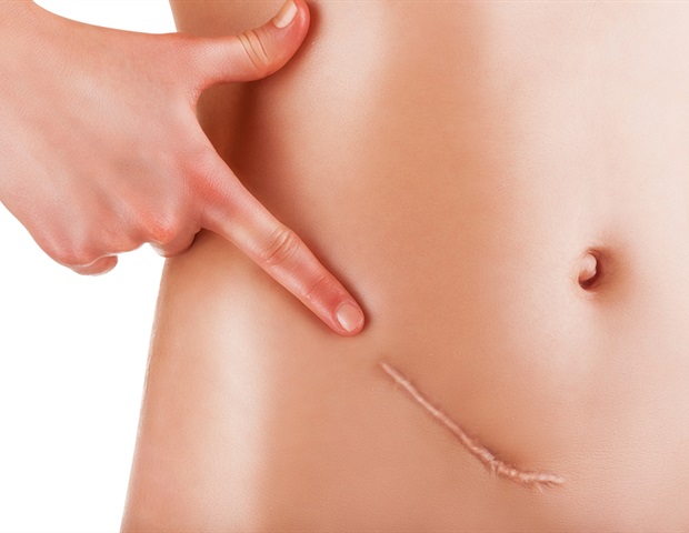 new-blood-test-offers-promising-advances-in-ovarian-cancer-treatment