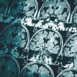 new-study-reveals-men-experience-faster-brain-shrinkage-with-age