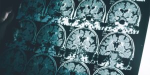 new-study-reveals-men-experience-faster-brain-shrinkage-with-age