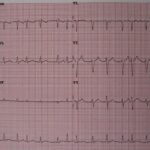 new-study-shows-one-month-clot-prevention-post-stent-as-effective-as-year-long-treatment-for-afib
