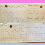 young-woman-s-heart-attack-linked-to-oral-contraceptive-use-a-case-study
