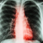 acute-rheumatic-fever-and-heart-disease-in-queensland-a-deep-dive-into-inequities