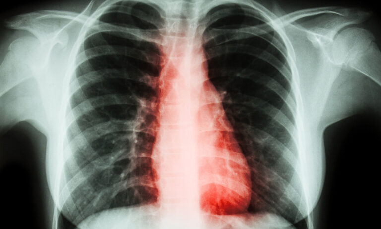 acute-rheumatic-fever-and-heart-disease-in-queensland-a-deep-dive-into-inequities