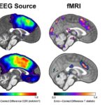 dual-brain-scans-enhance-teen-anxiety-predictions-study-finds