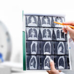 early-detection-key-in-combating-lung-cancer-mortality-in-the-u-s-