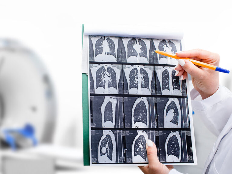 early-detection-key-in-combating-lung-cancer-mortality-in-the-u-s-