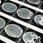 new-zealand-woman-s-brain-tumor-disappears-baffling-doctors