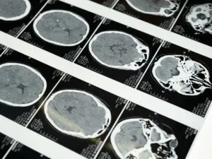 new-zealand-woman-s-brain-tumor-disappears-baffling-doctors