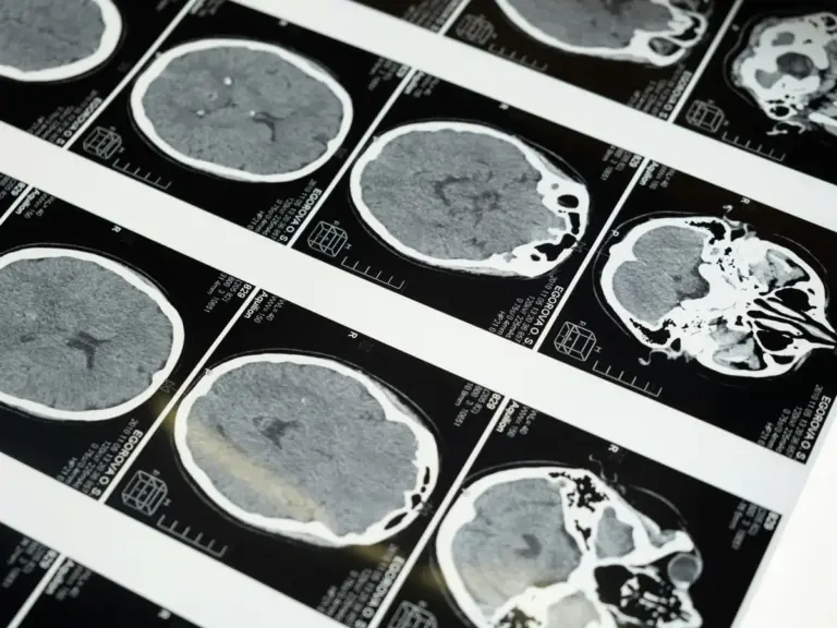 new-zealand-woman-s-brain-tumor-disappears-baffling-doctors