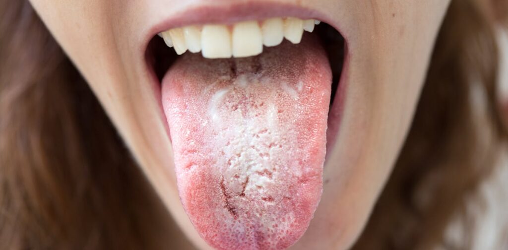 rising-antifungal-resistance-threatens-effective-thrush-treatment