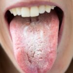 rising-antifungal-resistance-threatens-effective-thrush-treatment