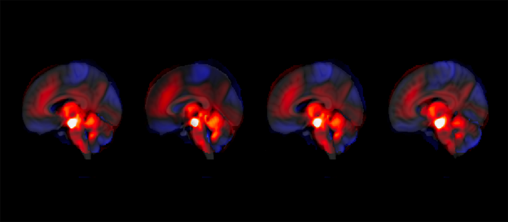 cerebellum-s-surprising-role-in-schizophrenia-unveiled