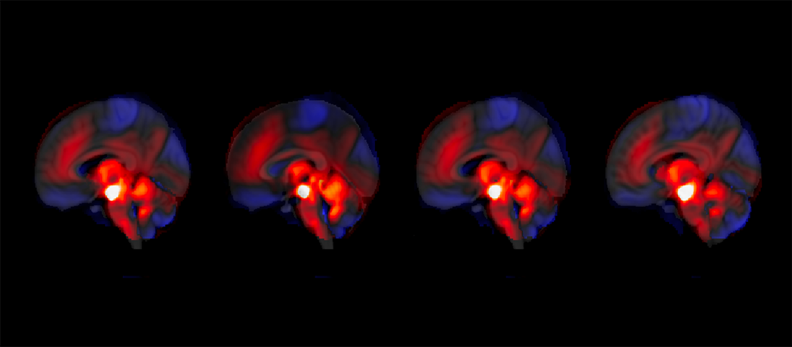 cerebellum-s-surprising-role-in-schizophrenia-unveiled