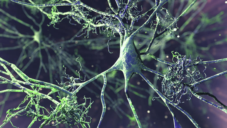 Nerve cells affected by Alzheimer's disease, illustration