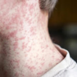 measles-alert-issued-at-sydney-airport-amid-southeast-asia-outbreaks