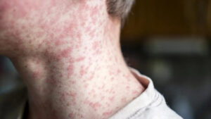 measles-alert-issued-at-sydney-airport-amid-southeast-asia-outbreaks