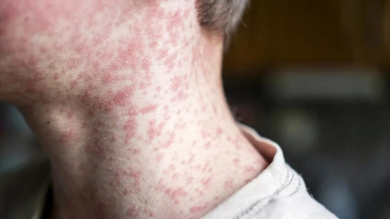 measles-alert-issued-at-sydney-airport-amid-southeast-asia-outbreaks