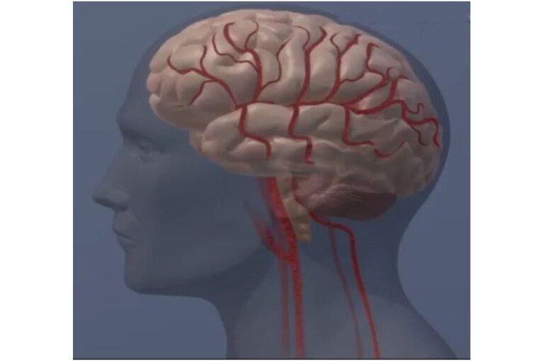new-study-finds-no-increased-stroke-risk-from-neck-artery-aneurysms