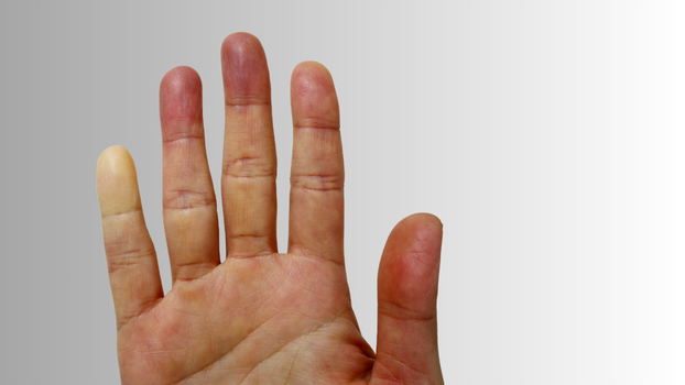 botox-offers-new-treatment-hope-for-autoimmune-related-finger-ulcers