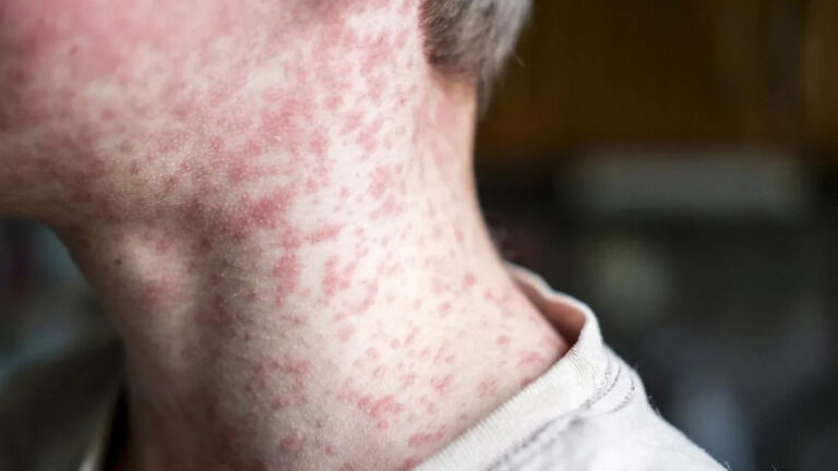 measles-alert-in-western-sydney-health-officials-urge-vigilance
