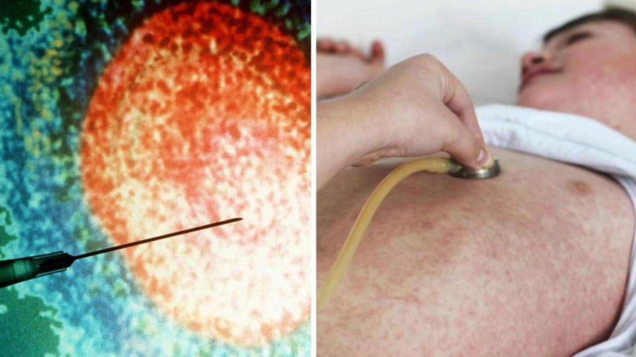 measles-outbreak-in-perth-new-case-prompts-health-alert