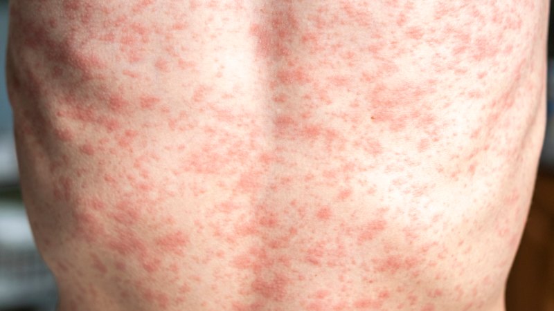 mystery-measles-cases-emerge-in-sydney-amid-undetected-spread
