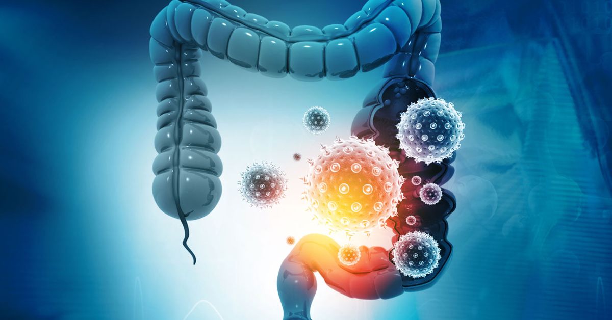 rising-bowel-cancer-rates-in-young-australians-linked-to-gut-microbiome