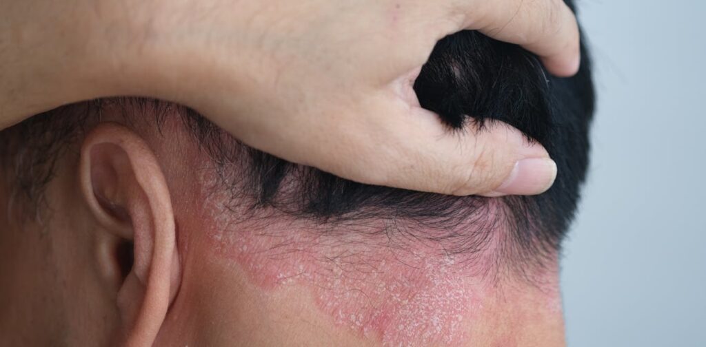 weight-loss-and-psoriasis-how-shedding-pounds-can-improve-skin-health